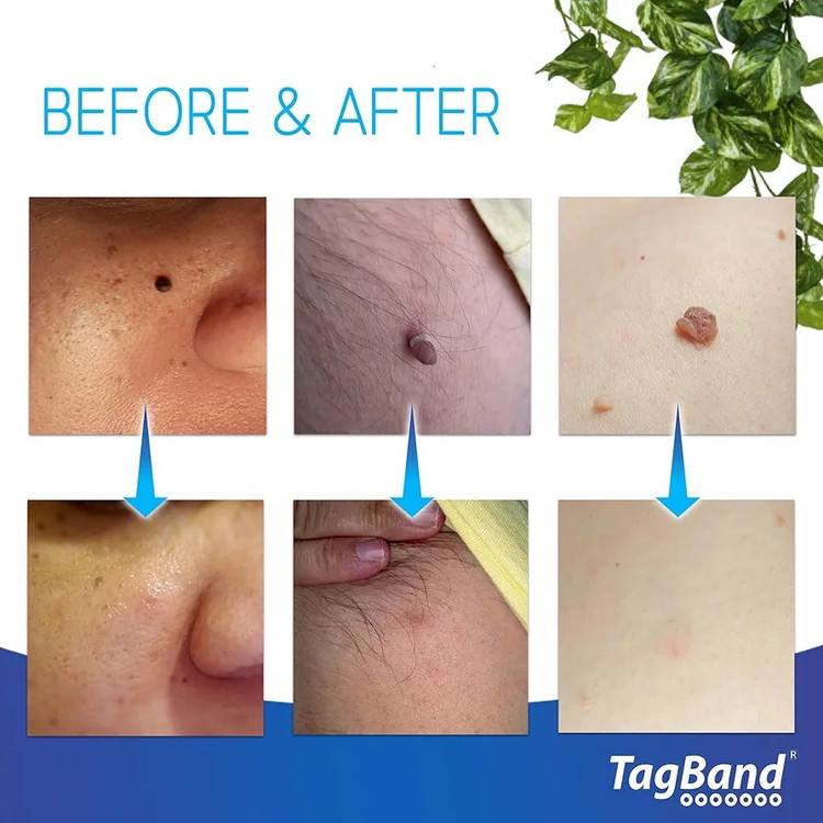 دستگاه پاک کننده زائدهای پوستی Auto TagBand